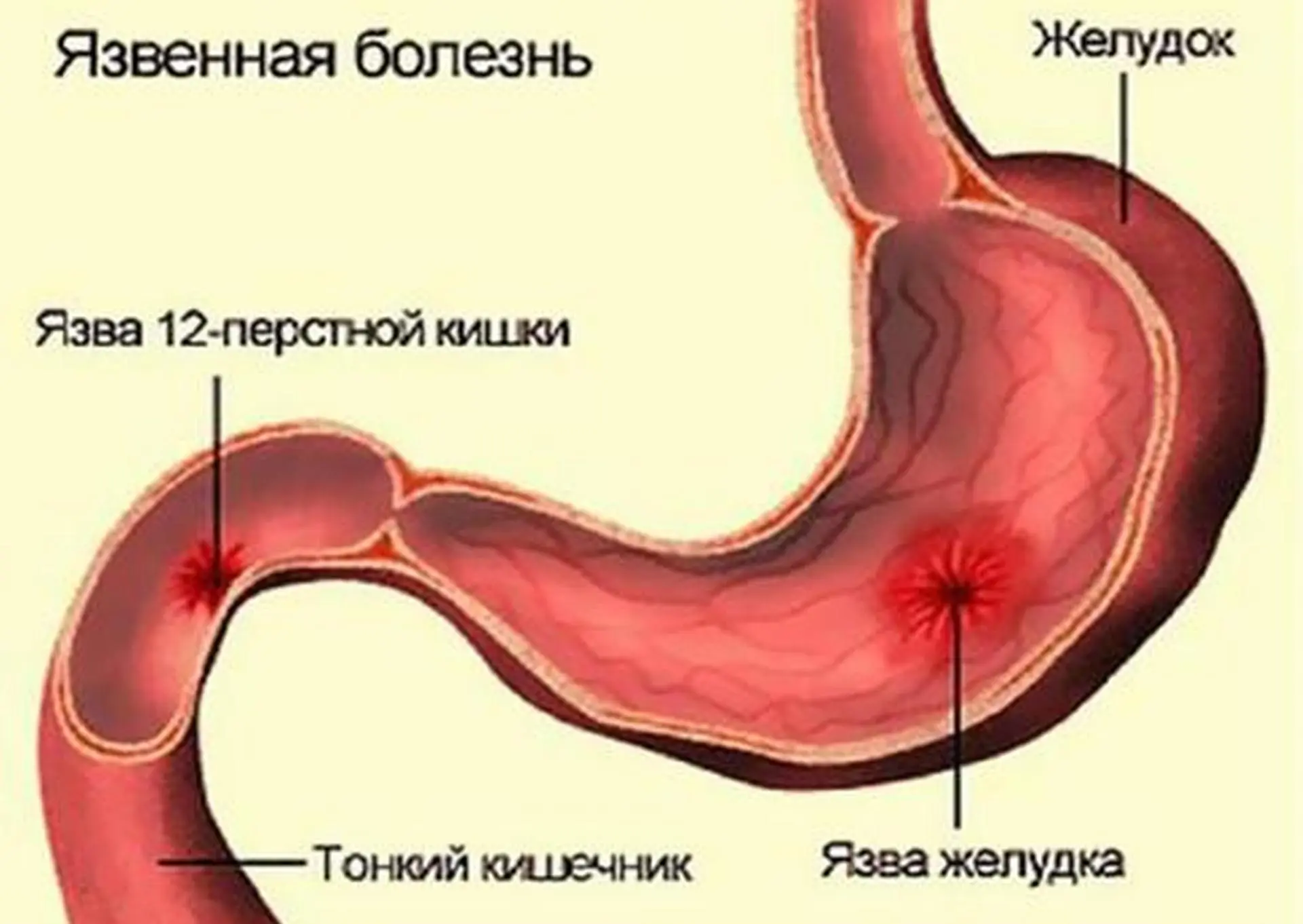 Заболеванием желудка является